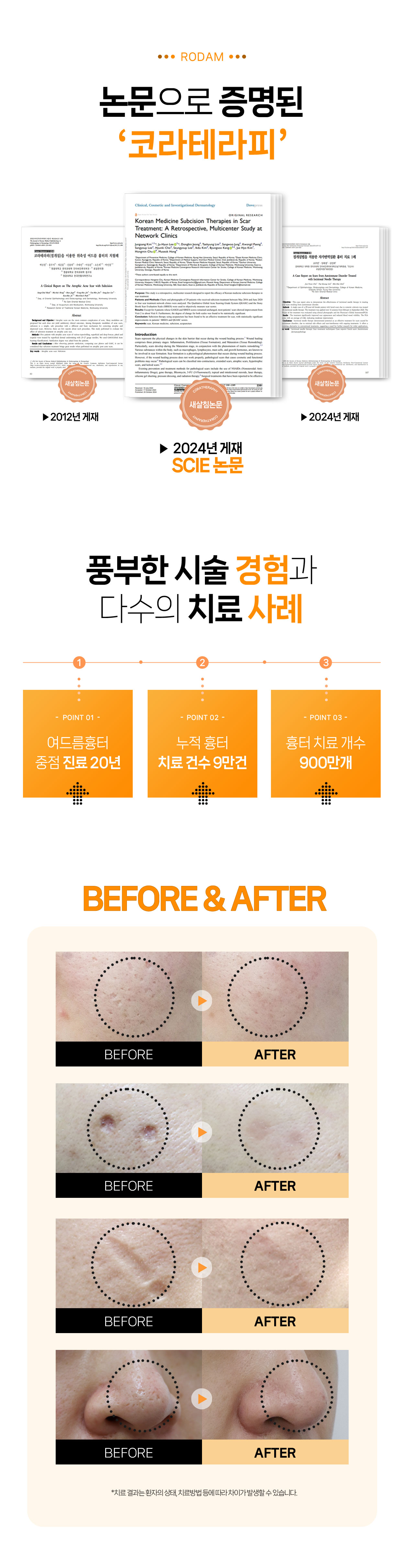 로담한의원 부산점입니다. 새살침으로 부산여드름흉터, 부산수두흉터, 부산성형흉터, 부산수술흉터, 부산얼굴패인흉터를 집중해서 치료합니다. 부산새살침치료, 부산한방피부과, 부산점 로담한의원 새살침 코라테라피가 시작된 곳