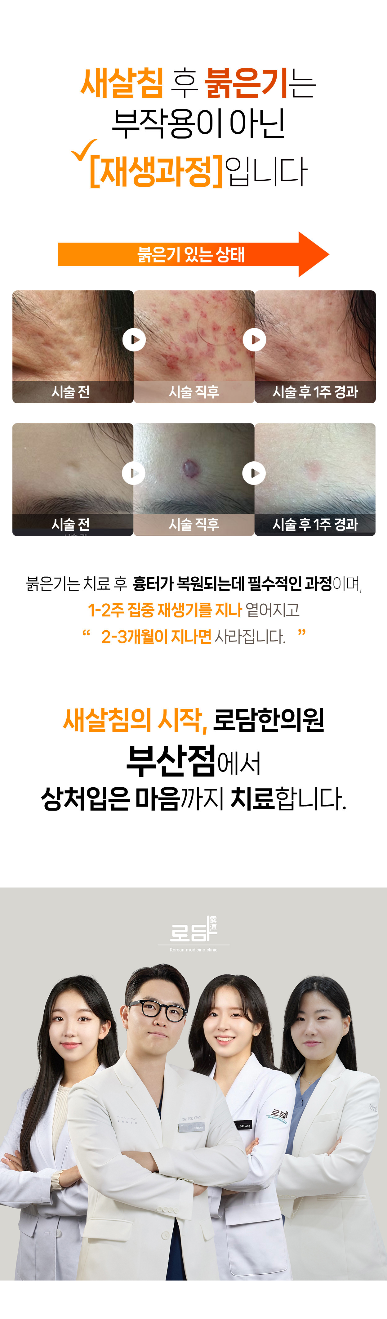 로담한의원 부산점입니다. 새살침으로 부산여드름흉터, 부산수두흉터, 부산성형흉터, 부산수술흉터, 부산얼굴패인흉터를 집중해서 치료합니다. 부산새살침치료, 부산한방피부과, 부산점 로담한의원 새살침 코라테라피가 시작된 곳